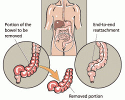 Bowel Resection Surgeon in Nashik | Laparoscopic Surgeon in Nashik Hernia Surgeon in Nashik |GallBladder Surgeon in Nashik