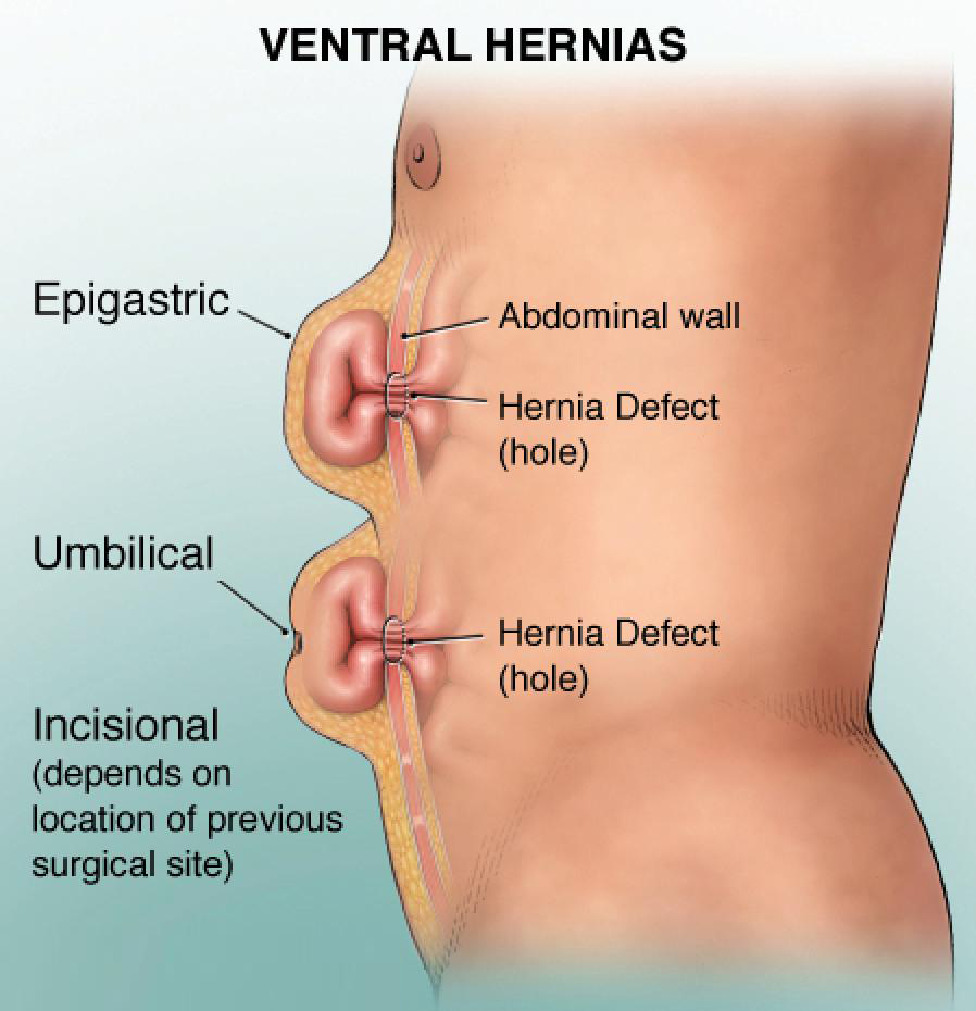 Hernia treatment | Saru Hospital |Antargala treatment