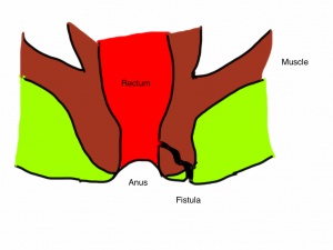 Laser Treatment for Fistula in Ano in Nashik
