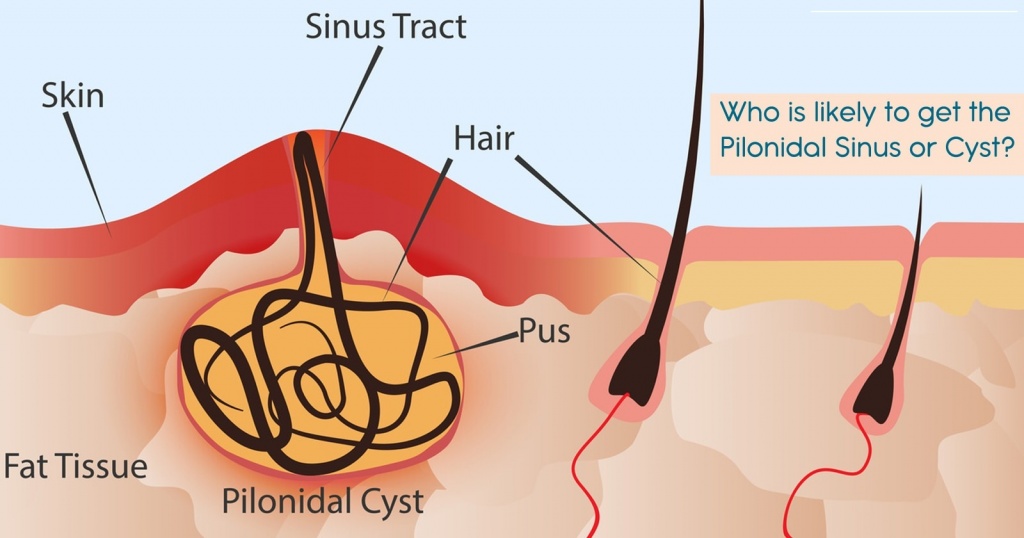 Pilonidal Sinus Treatment in Nashik