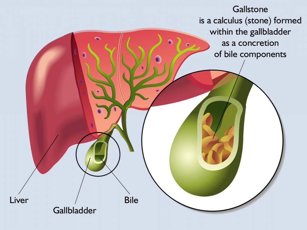 What are Gallstones or Gallbladder stones?