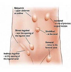 Hernia Surgeon in Nashik | Dr Sachin Deore